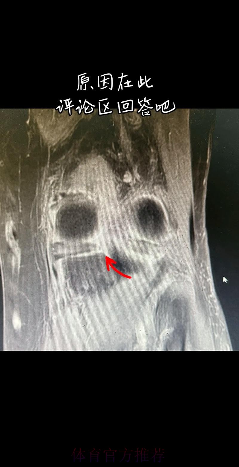 官方：阿拉巴左膝内侧半月板撕裂 预计伤缺6-8周